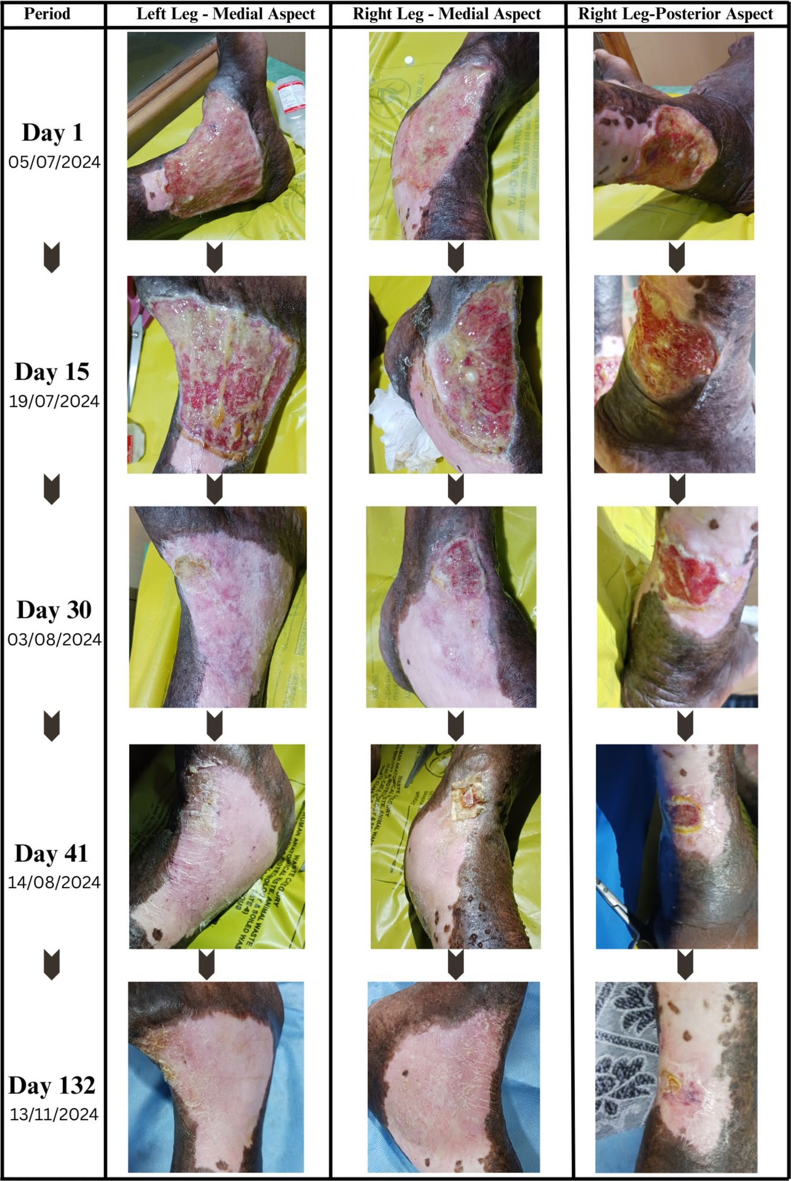 Clinical progression of chronic venous leg ulcers from Day 1 to Day 132
