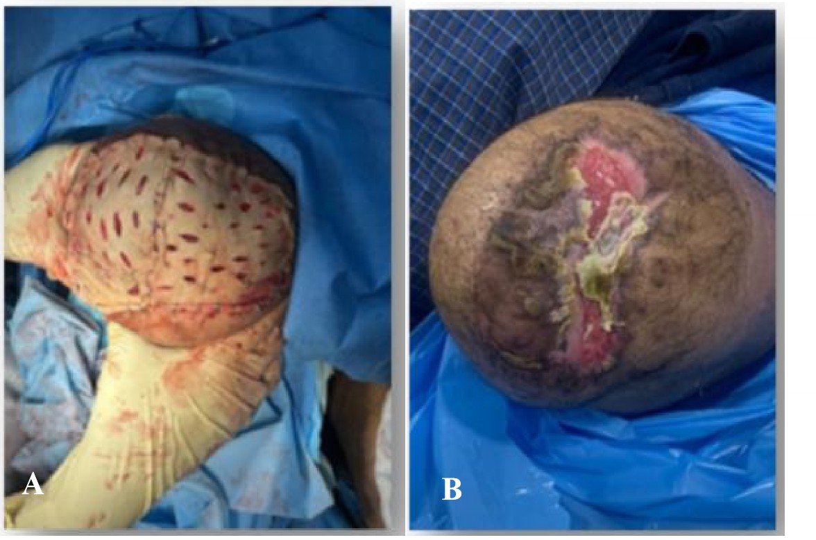 Clinical images showing pre-intervention wound status and partial skin graft failure
