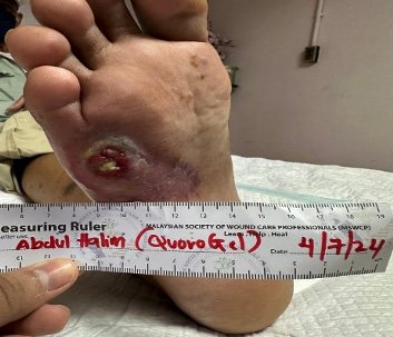 Clinical case study showing QuoroGel primary wound dressing treatment on complex chronic wound